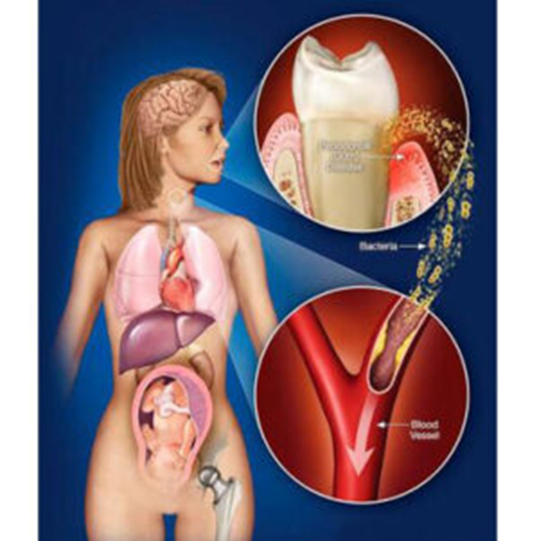 Pacientes con periodontitis corren mucho riesgo con la Covid-19 2 image 1