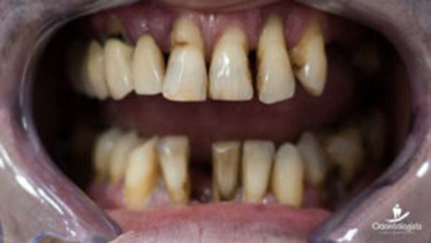 Pacientes con periodontitis corren mucho riesgo con la Covid-19 1 image